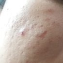 안심한의원 | 여드름흉터한의원 원인 새살 시술 후기