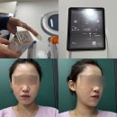 알파영등포 | 영등포시장역피부과 덴서티알파팁 슈링크 후기(유지기간, 효과)