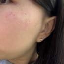 녹십자의원 | 가음정 녹십자 의원 오픈런 후기 ( 점, 잡티, 검버섯, 쥐젖 제거 / 점제거 후 관리 팁 )