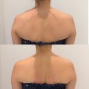 대광컴퓨터 | 광주북구피부관리✨ 하이퍼소닉으로 목·승모근·어깨까지 풀리는 극락 관리! 이플에스테틱 후기