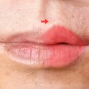 칠곡대학약국 | 대구입술문신 반영구적으로 얼굴빛을 환하게 남자 여자 이벤트 (부작용 헤르페스 관리법)