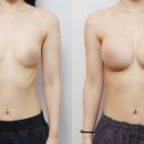 우일빌딩 | 가슴성형 비용만 보면 놓치는 것들 결국 중요한 건 의사 경력