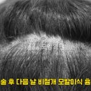 중앙헤어라인 이미지