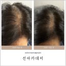 전주 두피관리 선아카데미 탈모관리 헤어라인