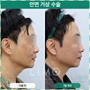 세련신경과의원 | 안면거상 병원 추천 기준을 세밀하게 따져본 이유