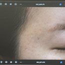 대구한의원 | 여드름패인흉터 새살침 치료 후기 가격 대구동성로 한의원에서