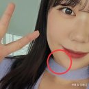 [강남병원/리모성형외과] 드디어 없애버린 투턱 이중턱살 제거+근육묶기 후기