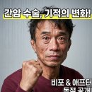 그랜드레슬링 | 심권호 간암 수술 후 얼굴 변화, 3개월 만에 일어난 기적 같은 비포 애프터 TOP 3