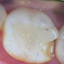 조은에스치과의원 | 은평 서울에스치과의원 치아(이)나 기존 인레이 깨졌을 때 대처법과 크라운 씌우기 1주차 후기 및 비용