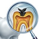 신경치료 한 치아는 반드시 씌워야 하나요? 이미지