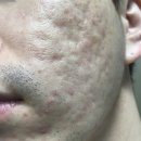 늘좋은한의원 | 여드름흉터한의원 선택 전 알아두면 좋은 실제 후기