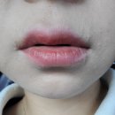 오금중앙약국 | [15주~25주] 임신 중기 임산부 습진 임산부 소양증 시작 그리고 뜻밖의 원인