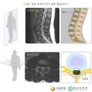 [튼튼병원 풍선확장술치료]"척추관협착증치료-풍선확장술!" 이미지