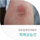 부산센텀화폐상습진 생기한의원과 함께라면