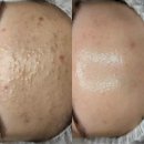 답십리5 | 여드름 없애는 생활습관 5가지｜답십리 쁨샵 스킨앤브로우 실제 관리 후기