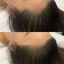 헤어끌레어 | 헤어라인 반영구 후기:올림머리 자신감 찾은 비포애프터 (대구 대명동 끌레어뷰티)