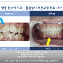 드라큘라치과의원 | 발치없는 앞니교정 후기 - 명동 한번에 치과