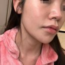 대구 달서구 잡티제거 전문 피부과 추천/ 피코슈어 줌패스 + 토닝 2회 후기