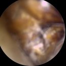 샘보청기 | 청주보청기 귀지 이비인후과에서 제거를 하셔야 하는 이유