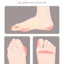 연성중앙약국 | 갑자기 왜 나는거지? 굳은살과 티눈