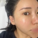 에스와이바른피부과의원 | 홍대피부과 물광주사 가격 효과 시기 통증 피부 전후 후기