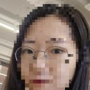 팝성형외과의원 | [내돈내산] 팝성형외과 쌍꺼풀 수술 했어요! 수술 후 1년차 후기 (쏘 씸플)