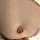 배꼽 | 신생아 배꼽 육아종 치료후기 / 봄빛병원,분당차병원