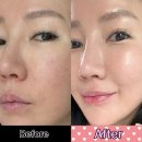 주)울토 | [OPEN]홈케어디바이스 미친템 '울트라토닝' 레이저토닝+프락셀+고주파 관리를 동시에!!
