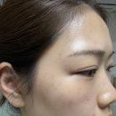 부산 편평사마귀 제거하고 꿀피부된 후기(일주일간 변화 사진있음)