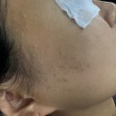 삼성피부과 포텐자 콜라스터 PDRN 후기, 비용, 부작용