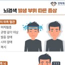 뇌혈관 겨울철 허혈성 출혈성 뇌졸중 원인 과 이미지