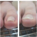 발톱닥터