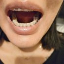 미소준치과기공소 | 치아교정잘하는치과 잇몸미소 개선 후기! - 19개월