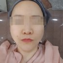 연신내 메이퓨어의원 리비힐 스킨부스터 &amp; LDM 관리 후기! 촉촉한 물광 피부 만들기