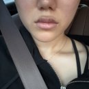 뚜뚜의원 | 내돈내산 뚜뚜의원 보톡스 , 입술필러 솔직후기