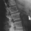 퇴행성 척추염(degenernative spondylitis) 이미지