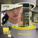 뷰티갤러리샘 | 강남 피부과 추천 더나의원에서 받은 티타늄리프팅 전후 유지기간 등 솔직 후기