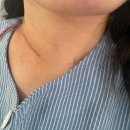 예스병원 | [예스클리닉] &#39;100번째&#39; 수술 이벤트 당첨기념 &amp; 완벽했던 수술 찐 후기