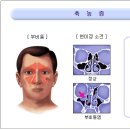 부비동염( Paranasal sinusitis ) 이미지