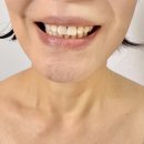 신사역치과 치아미백 레브치과 일주일차 솔직후기 홈케어 방법