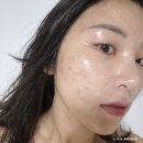 연신내 피부과 추천 은평구 피부과 네오빔 여드름관리 후기,가격,부작용 등