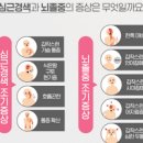 뇌출혈 뇌졸중 초기 및 정보원인 (후유증) 이미지