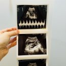 동수김원호내과의원 | [임신일기-14주] NIPT 검사결과, 신경관결손검사의뢰, 임산부 편도염