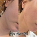 유케이성형외과 | [해운대 성형외과] 부산 슈링크 300샷 시술 효과 솔직후기 - 1
