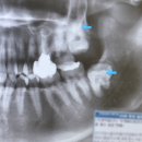 DB | 의정부 사랑니발치 비용 통증 등 매복사랑니 발치후기 DB손해보험 실비청구 방법