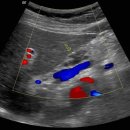 Intraductal papillary mucinous neoplasm.(IPMN) 이미지