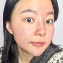 홍대피부과 입가처짐, 팔자주름 라인 로리앙 필러카세 전후비교 솔직후기