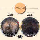 헤어G.GMA(컷트전문점) | [두피문신할인전문점] 펌으로는 커버 안 되던 정수리 탈모, 결국 선택한 두피문신 1차 결과는?
