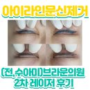 현의원 | 2차] 반영구아이라인문신제거 2차 내돈내산후기 숙원사업 (前수아미, 현 브라운아이의원 후기, 꼭!가세요~)