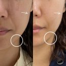 올의원 | 대구 H의원 올타이트리프팅 솔직후기